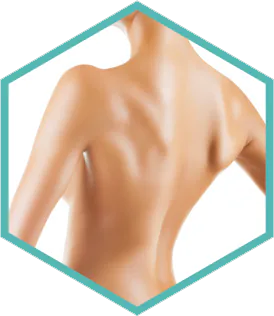 Illustrative back treatment area for Morpheus8 at Square Mile Clinic, City of London
